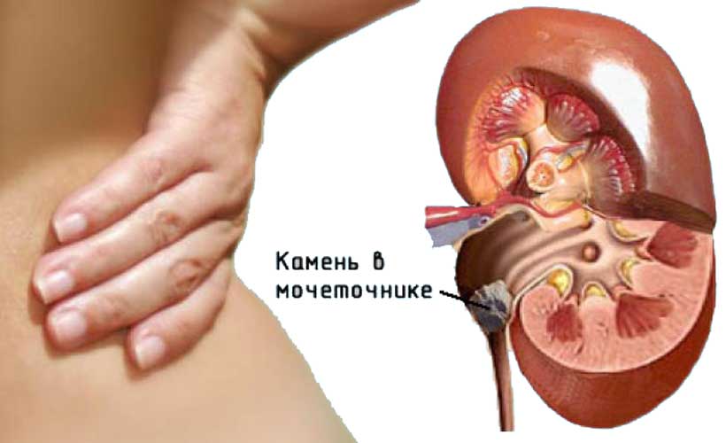 Камень в почке